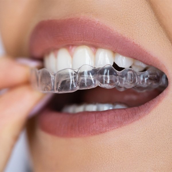 aligner-methoden-kieferorthopaedie-behandlung-praxis-am-fronwagplatz-zahnarzt-schaffhausen aligner-methoden-kieferorthopaedie-behandlung-praxis-am-fronwagplatz-zahnarzt-schaffhausen